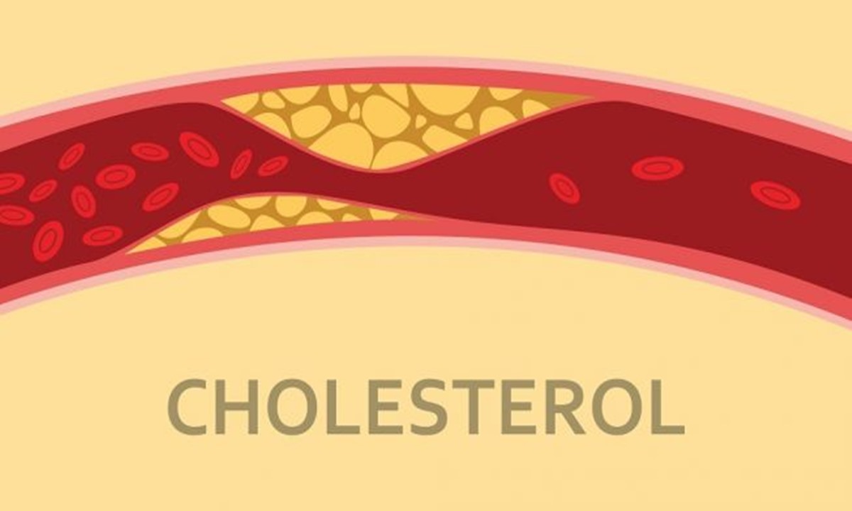 Cek Kolesterol Tinggi Lingkaran Bola Mata