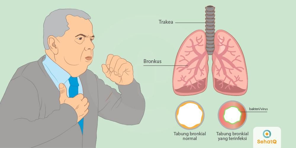 Penyebab Batuk dengan Dahak ataupun Lendir Warna Putih